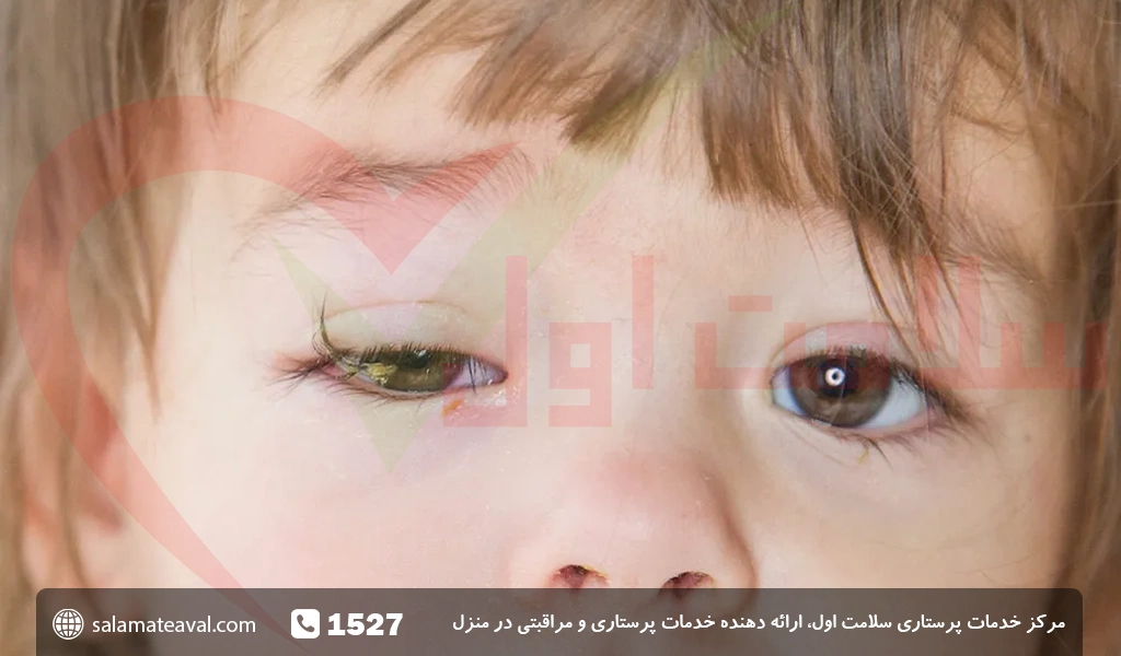 عفونت‌های ویروسی، شایع‌ترین بیماری چشم در فصل گرما - ایرنا