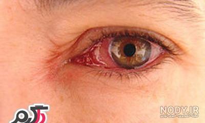 قرمزی چشم از علائم ابتلا به کرونا است قرمزی چشم از علائم ابتلا به کرونا است