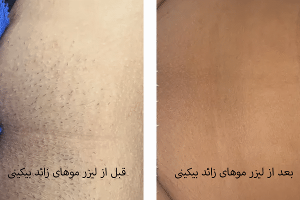 💢 نمونه‌ای از لیزر موهای زائد بیکینی ✓✓✓ عکس ارسالی توسط خود مراجعه کننده  بعد از 6 جلسه @dr.shadibehfar شماره تماس جهت دریافت دریافت نوبت ویزیت 📞  09216776358 شماره تماس