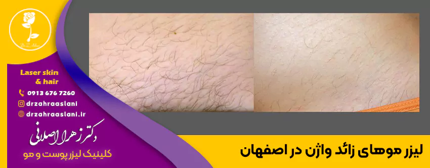 آشنایی با لیزر موهای زائد بدن، مزایا و عوارض آن - کلینیک زیبایی شن های نقره ای فرمانیه آشنایی با لیزر موهای زائد بدن، مزایا و عوارض آن - کلینیک زیبایی شن های نقره ای فرمانیه