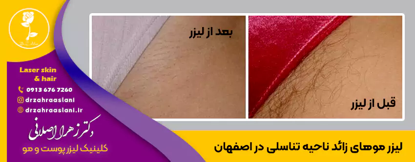 بهترین لیزر موهای زائد زیر بغل، جلسات و مراقبت های بعد از لیزر ❤️ + فیلم و  عکس ✔️ | مرکز زیبایی و لیزر