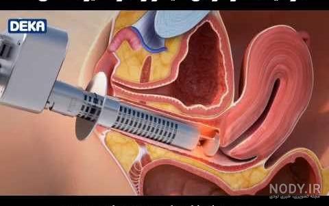 تاثیر لیزر مونالیزا تاچ در درمان بی اختیاری ادرار (دکتر مهدیه کمالی) – دکتر  مهدیه کمالی