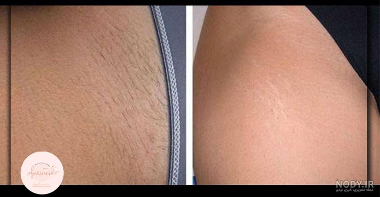خجالت ميكشم عکس لیزر موهای زائد ناحیه تناسلی بیکینی
