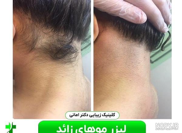 عکس قبل و بعد از لیزر مو های زائد - تهران کلینیک