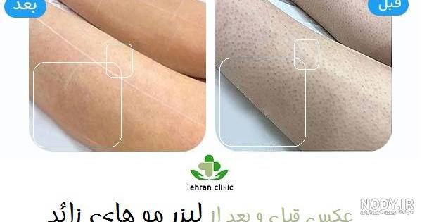 عکس قبل و بعد از لیزر مو های زائد - تهران کلینیک
