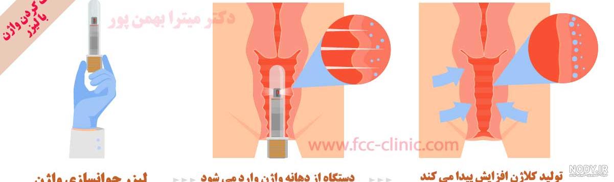عکس قبل و بعد لیزر مونالیزا