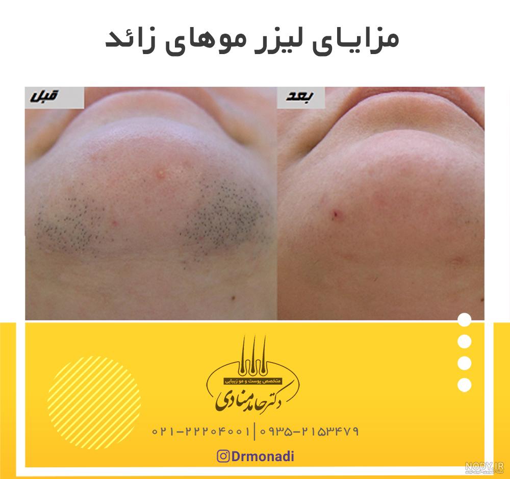 عکس قبل و بعد لیزر موی زائد