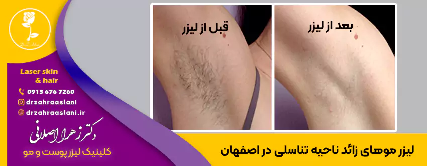 عکس لیزر موهای زائد بیکینی عکس لیزر موهای زائد بیکینی