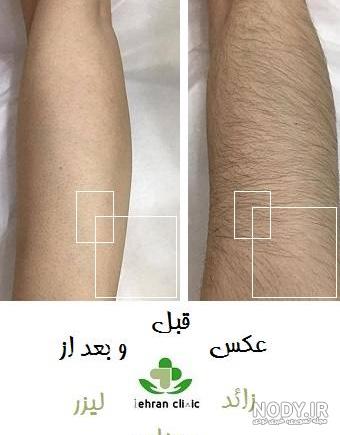 قبل از لیزر بیکینی چه کنیم؟ | قبل و بعد لیزر بیکینی