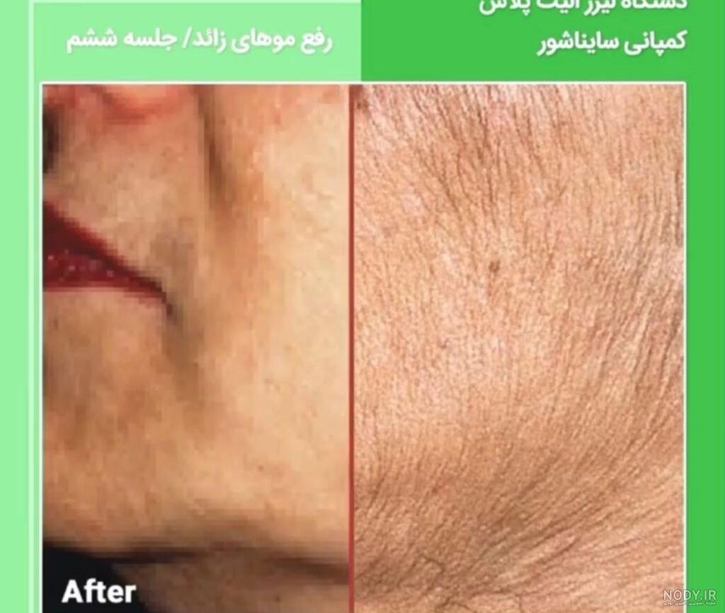 لیزر موهای زائد بدن + عوارض و مراقبت ها | کلینیک بهارین