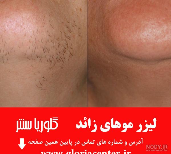 لیزر موهای زائد بدن + عکس قبل و بعد از لیزر بدن | دکتر تفت لیزر موهای زائد بدن + عکس قبل و بعد از لیزر بدن | دکتر تفت