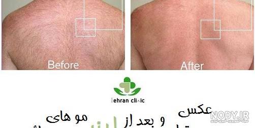 لیزر موهای زائد بدن + عکس قبل و بعد از لیزر بدن | دکتر تفت