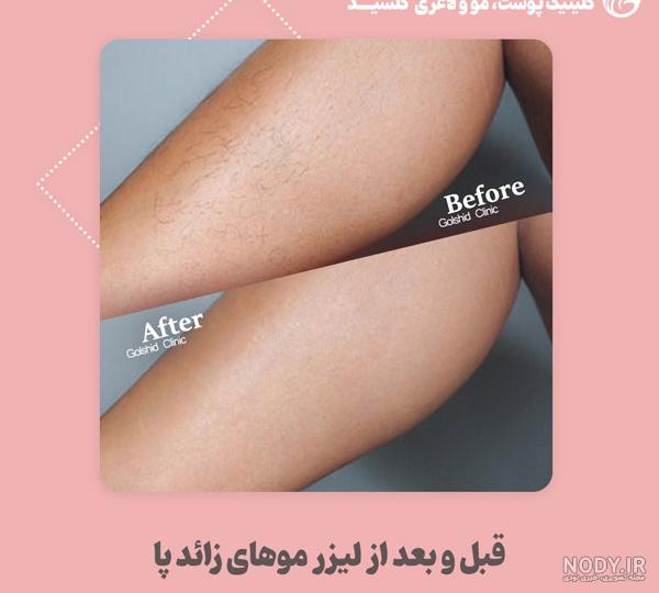 لیزر موهای زائد بیکینی ❤️ + فیلم و عکس ✔️ لیزر الکس کندلا + مشاوره رایگان | مرکز زیبایی و لیزر لیزر موهای زائد بیکینی ❤️ + فیلم و عکس ✔️ لیزر الکس کندلا + مشاوره رایگان | مرکز زیبایی و لیزر