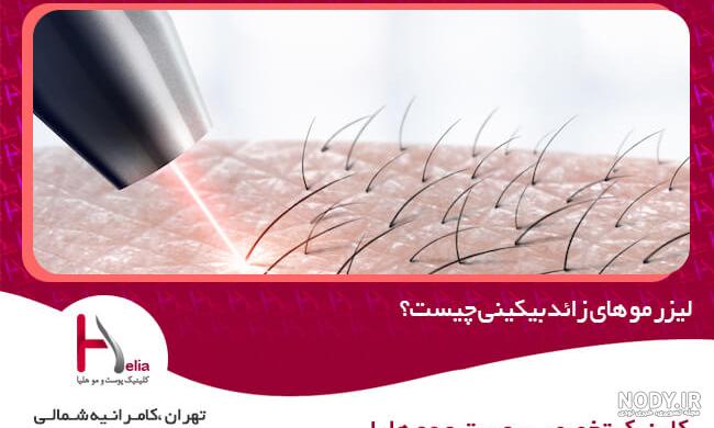 لیزر موهای زائد بیکینی ❤️ + فیلم و عکس ✔️ لیزر الکس کندلا + مشاوره رایگان | مرکز زیبایی و لیزر لیزر موهای زائد بیکینی ❤️ + فیلم و عکس ✔️ لیزر الکس کندلا + مشاوره رایگان | مرکز زیبایی و لیزر