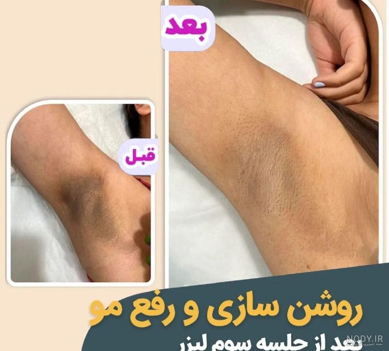 لیزر موهای زائد | فیلم لیزر موهای زائد | کلینیک پوست و مو نیل | شماره 11 لیزر موهای زائد | فیلم لیزر موهای زائد | کلینیک پوست و مو نیل | شماره 11