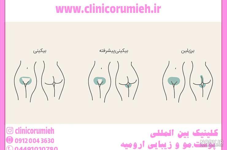 لیزر موهای زائد ناحیه تناسلی زنان ( بیکینی) - کلینیک هلیا لیزر موهای زائد ناحیه تناسلی زنان ( بیکینی) - کلینیک هلیا