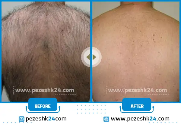 لیزر موهای زائد | کلینیک مهر کرج | درمانگاه تخصصی پوست و مو
