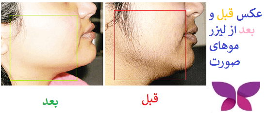 لیزر موهای زائد | کلینیک مهر کرج | درمانگاه تخصصی پوست و مو