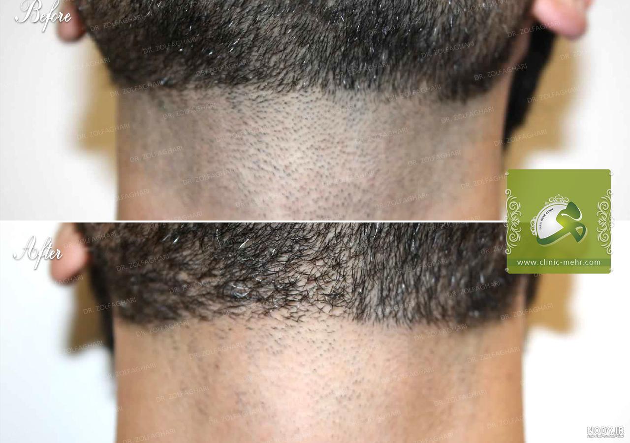 مرکز لیزر موهای زائد در رشت (قیمت + فیلم+ سوالات پر تکرار)