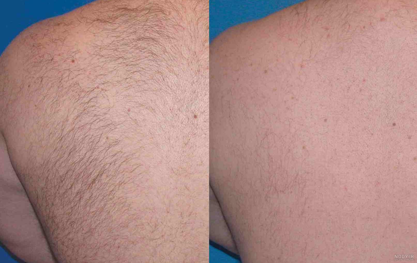 مزایای لیزر موهای زائد | لیزر موهای زائد | لیزر | جوانسازی پوست | دکتر حامد  منادی