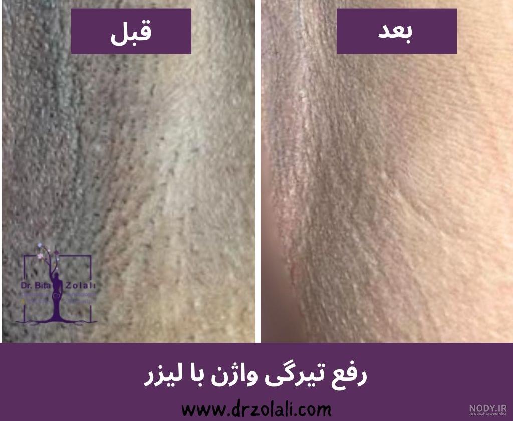 هزینه لیزر مونالیزا برای سفید کردن واژن - دکتر خلیلی