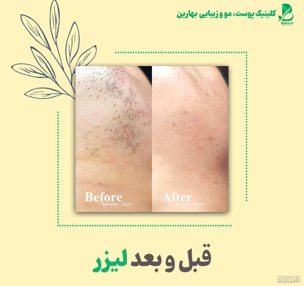 پرسش و پاسخ درباره لیزر