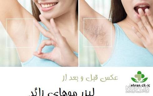 گالری تصاویر لیزر موهای زائد - کلینیک زیبایی رز آبی