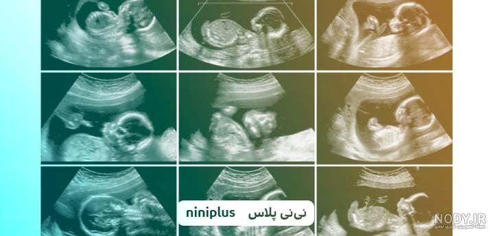 امروز رفتم سونو انومالی بچم پسر بود،ولی ان تی رفته...