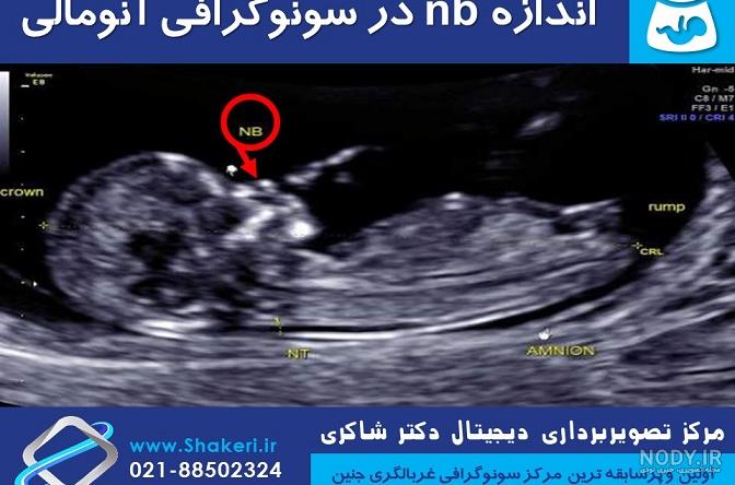 تا حالا دیدین تو سونو انومالی جنسیت با آدمک مشخص کنند؟ | تبادل نظر نی نی  سایت