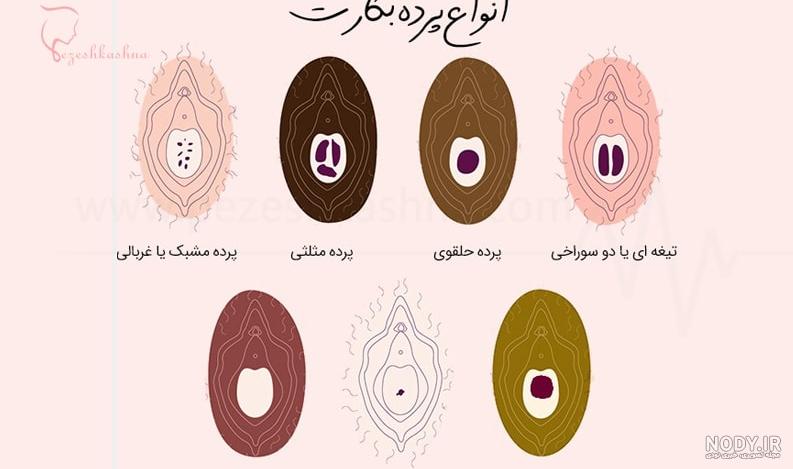 رفع کبودی زیر چشم بعد از عمل بینی | زمان لازم برای برطرف شدن - دکتر ...