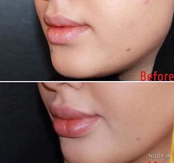 300 بار جراحی لب خواننده مشهور بعد از پروتز لب + تصاویر 300 بار جراحی لب خواننده مشهور بعد از پروتز لب + تصاویر
