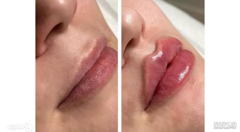 10 روش پروتز لب در خانه بدون عمل جراحی - دکتر گویا 👨‍⚕️