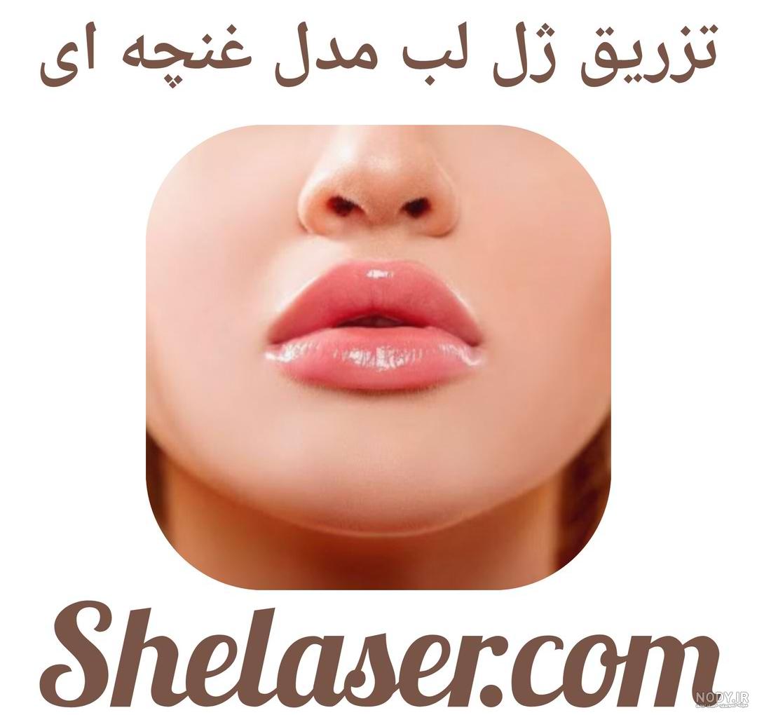 45 عکس زیبایی از تزریق ژل لب مدل عروسکی برای لبهایی جذاب