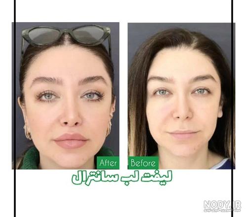 11 مورد از مراقبت های بعد از لیفت سانترال لب – دکتر حاجی بگلو 11 مورد از مراقبت های بعد از لیفت سانترال لب – دکتر حاجی بگلو