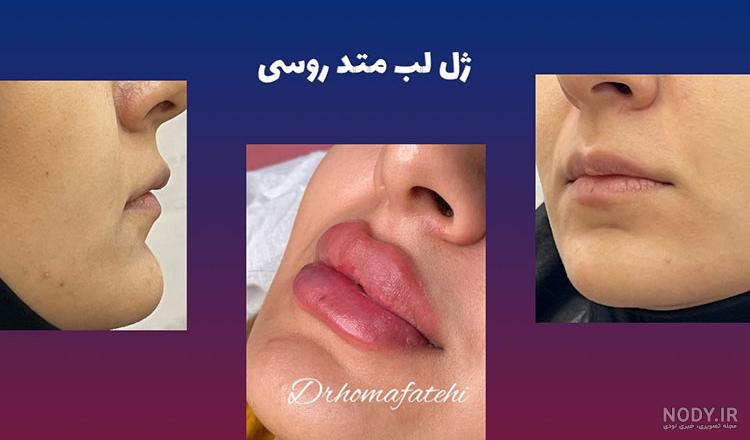 آشنایی با همه روش های لیفت لب به همراه عکس - بهترین کلینیک پوست و مو زیبایی شیراز آشنایی با همه روش های لیفت لب به همراه عکس - بهترین کلینیک پوست و مو زیبایی شیراز