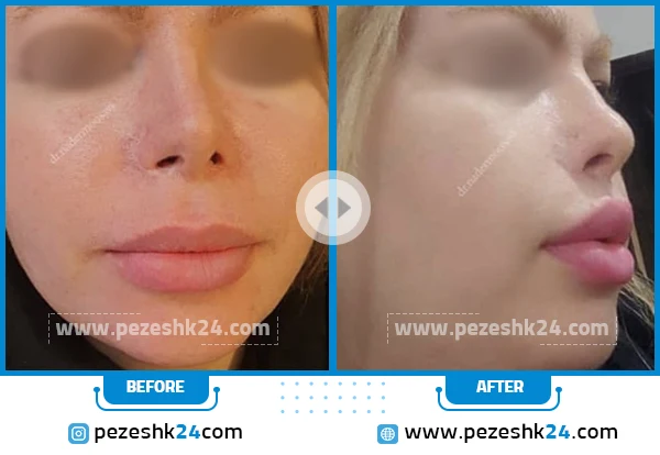 آیا ورم بعد از سانترال لب طبیعی است؟ ورم لب بعد لیفت چقدر طول میکشد؟ – دکتر حاجی بگلو آیا ورم بعد از سانترال لب طبیعی است؟ ورم لب بعد لیفت چقدر طول میکشد؟ – دکتر حاجی بگلو
