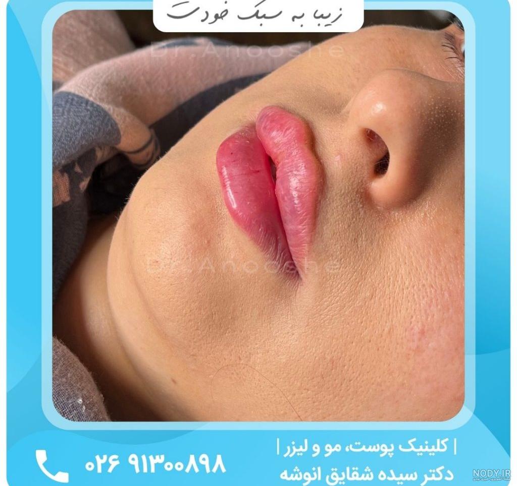 انواع تزریق ژل لب ؛ ژل لب روسی ، ژل لب عروسکی ، ژل لب قلبی ، پاریسی ، سوتی و فانتزی | ژل هیالورونیک اسید و ۲۲۶۱۸۷۲۹ و فروش بوتاکس در شرکت نیک NIK CO انواع تزریق ژل لب ؛ ژل لب روسی ، ژل لب عروسکی ، ژل لب قلبی ، پاریسی ، سوتی و فانتزی | ژل هیالورونیک اسید و ۲۲۶۱۸۷۲۹ و فروش بوتاکس در شرکت نیک NIK CO