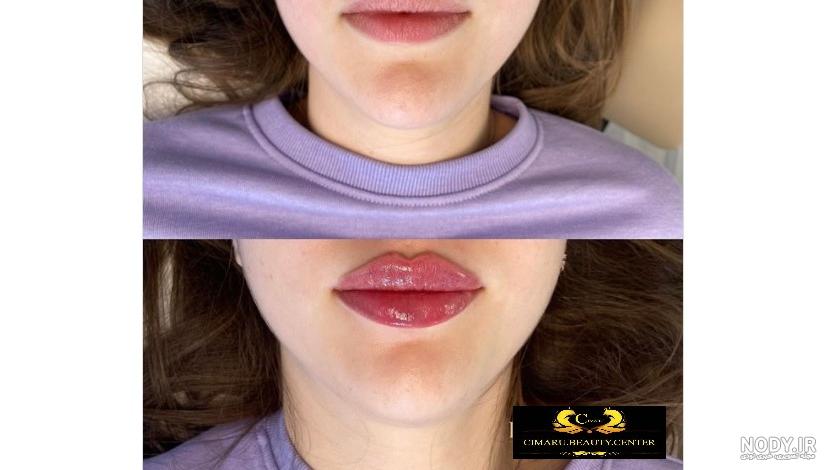 انواع تزریق ژل لب روسی و عروسکی در تهران | ژل لب مدل گرد و مدل قلوه ای انواع تزریق ژل لب روسی و عروسکی در تهران | ژل لب مدل گرد و مدل قلوه ای