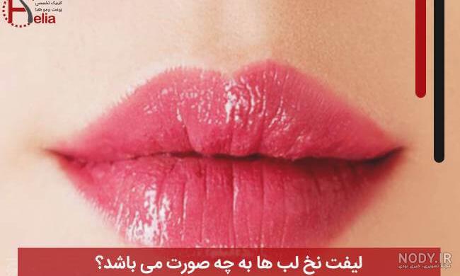 انواع لیفت لب - مجموعه زیبایی فیت پلاست انواع لیفت لب - مجموعه زیبایی فیت پلاست