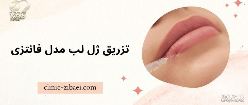 انواع مدل تزریق ژل لب (10 نوع مدل ژل لب + عکس و فیلم) انواع مدل تزریق ژل لب (10 نوع مدل ژل لب + عکس و فیلم)