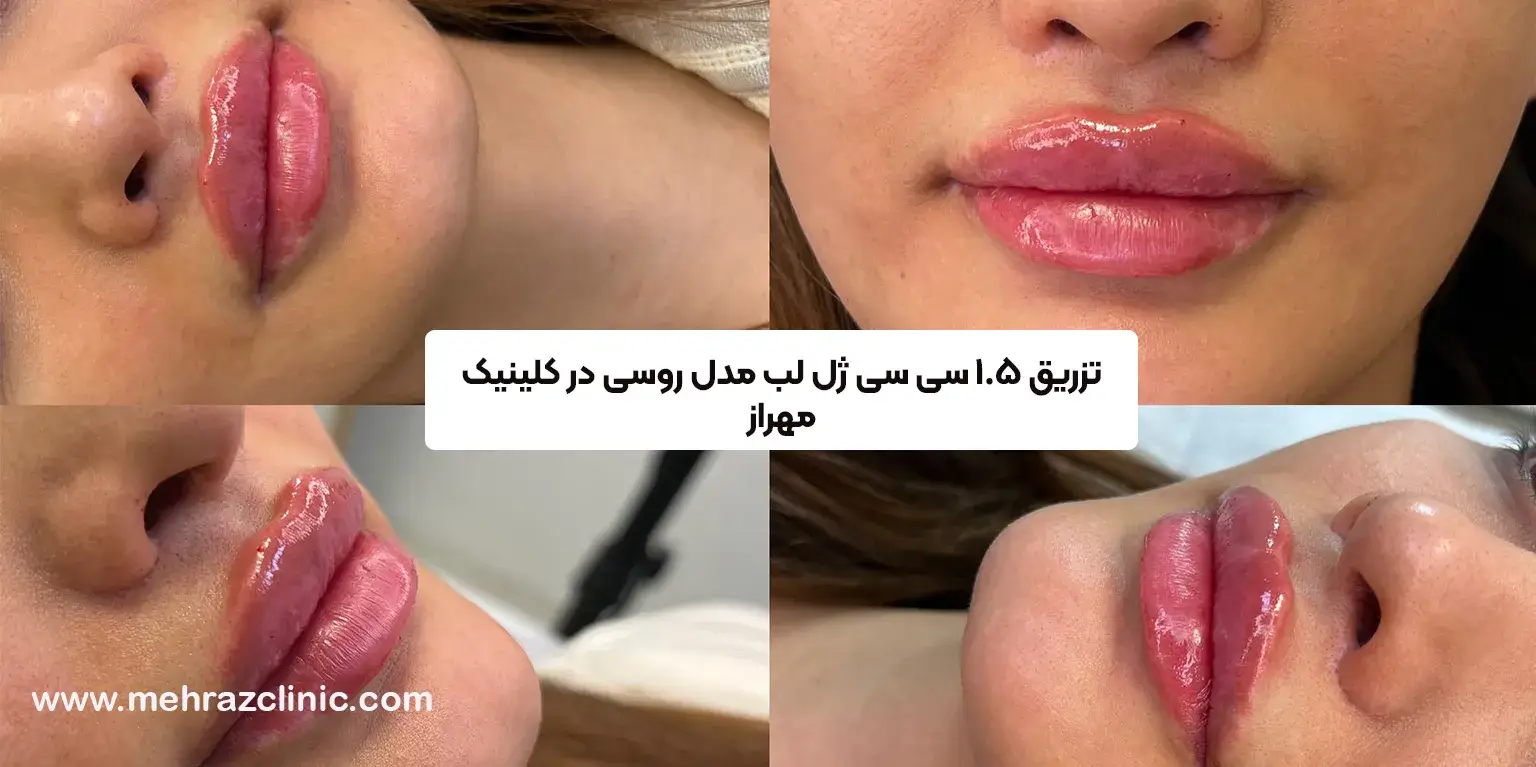 انواع مدل تزریق ژل لب+ عکس 6 مدل جدید لب در سال 2024 - کلینیک زیبایی رویای آبی انواع مدل تزریق ژل لب+ عکس 6 مدل جدید لب در سال 2024 - کلینیک زیبایی رویای آبی