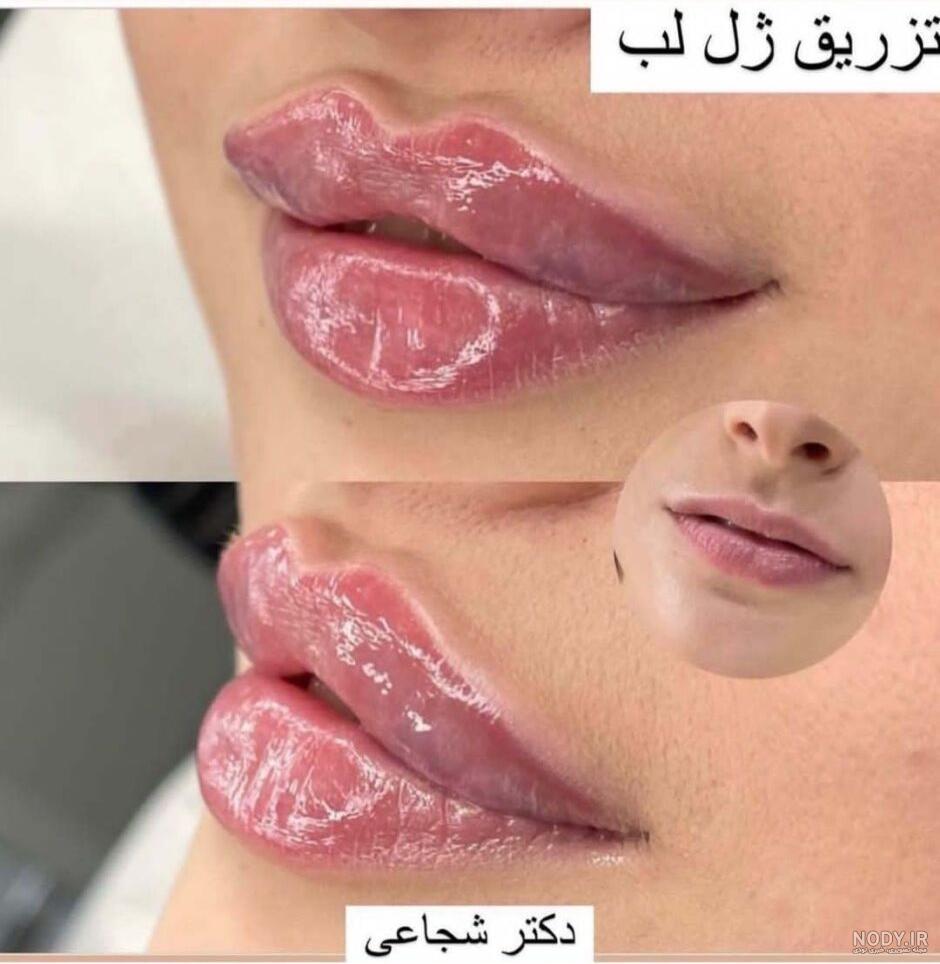 انواع مدل لب برای تزریق ژل { روسی، عروسکی، نچرال، کره ای} انواع مدل لب برای تزریق ژل { روسی، عروسکی، نچرال، کره ای}