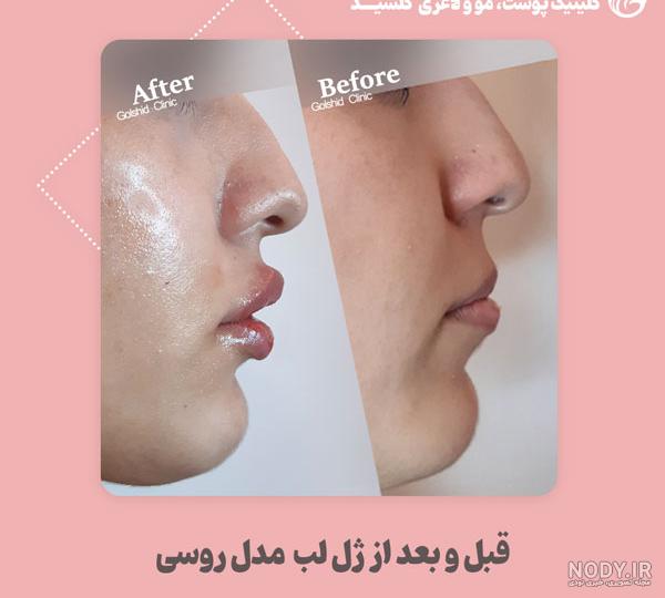 انواع مدل پروتز لب کدام‌اند؟؟ تفاوت‌های آن‌ها - دکتر لیلی هاشمی