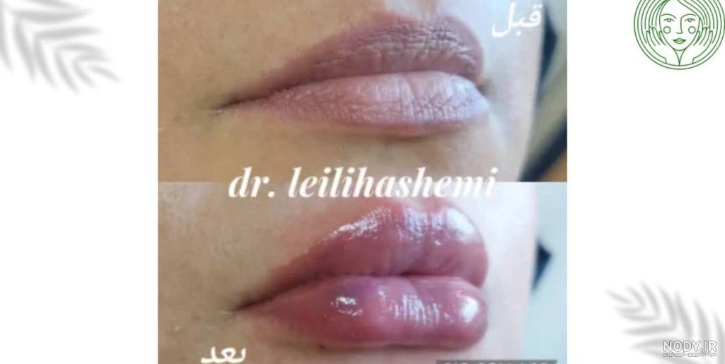 انواع مدل پروتز لب کدام‌اند؟؟ تفاوت‌های آن‌ها - دکتر لیلی هاشمی