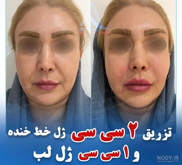 انواع ژل لب در کلینیک جهانشهر کرج، ژل روسی، طبیعی، عروسکی در کرج انواع ژل لب در کلینیک جهانشهر کرج، ژل روسی، طبیعی، عروسکی در کرج