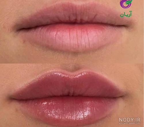 با عکس های قبل و بعد ژل لب می توانم فرم لبم را انتخاب کنم؟ - کلینیک دلتا با عکس های قبل و بعد ژل لب می توانم فرم لبم را انتخاب کنم؟ - کلینیک دلتا