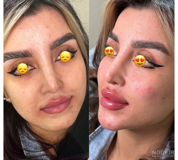 با مراقبت های پس از تزریق ژل لب عروسکی می توانید نتایجی ماندگارتر داشته  باشید.