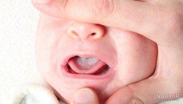 برای برفک دهان به چه دکتری مراجعه کنیم | داروی درمان برفک دهان