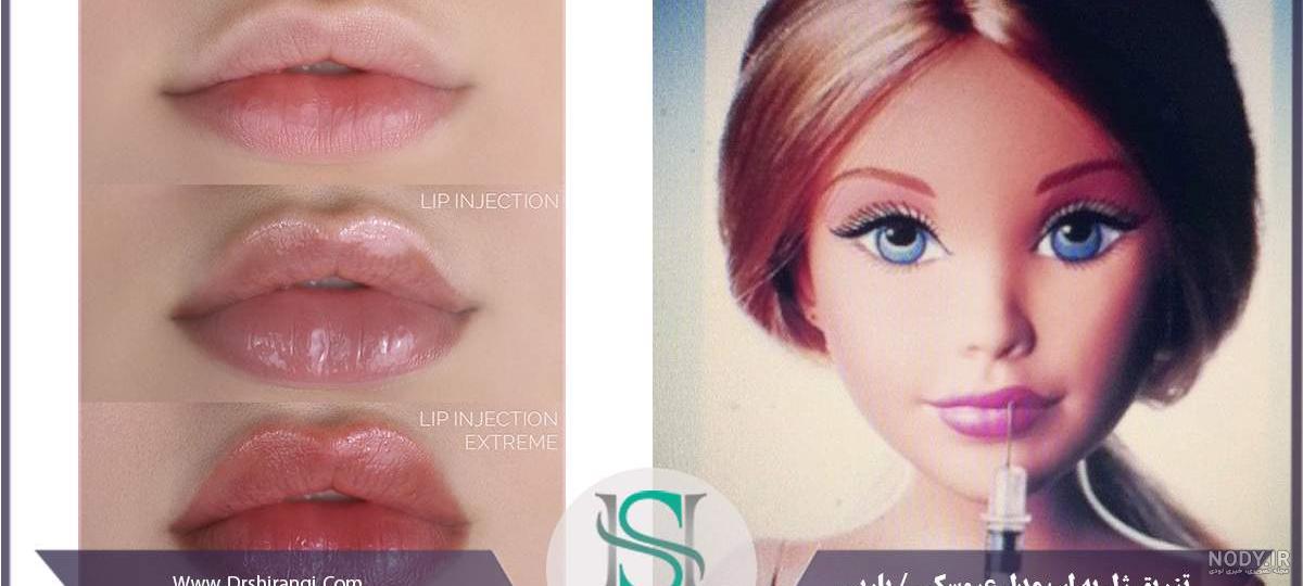 برای ژل لب روسی چند سی سی نیاز است ؟ | -برترین پزشک