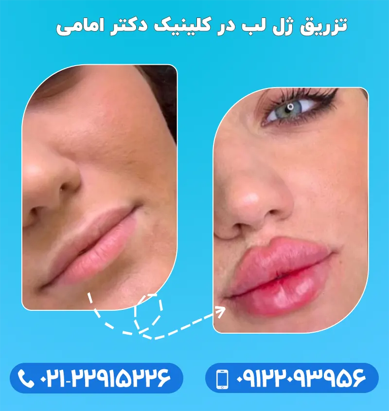 بررسی 5 روش برای فرم دهی لب در خانه - دکتر فهیمه مطلبی بررسی 5 روش برای فرم دهی لب در خانه - دکتر فهیمه مطلبی